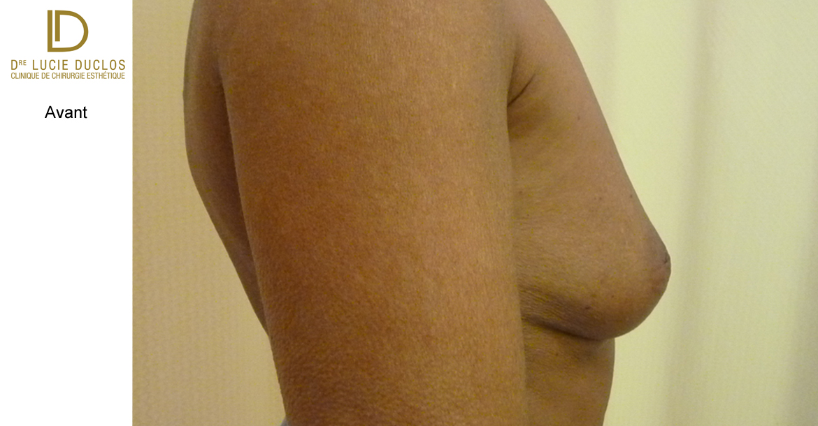 Before-pseudoptose et augmentation mammaire